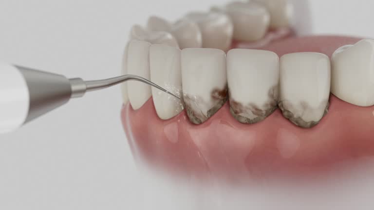 Reliable Tooth Extraction contractor in Mount Juliet, TN by Smile Center Dentistry